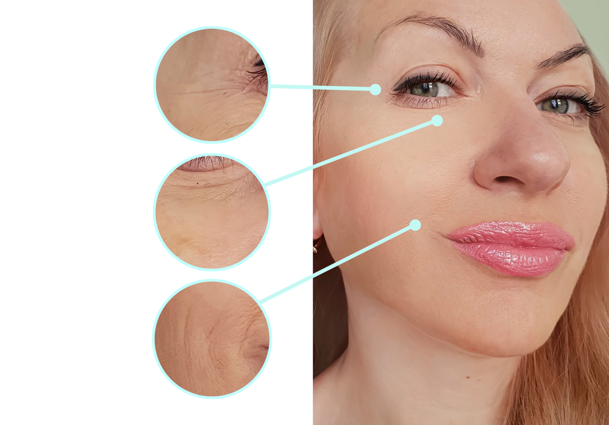 Kako mi je blefaroplastika ponovno odprla pogled